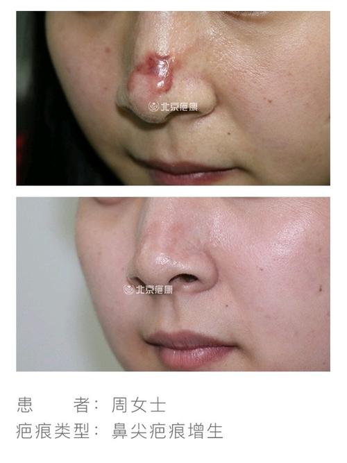 鼻尖受伤创面愈合后出现疤痕增生怎么办?