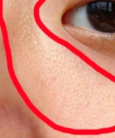 原来毛周角化真的会长到脸上!也太丑了吧!