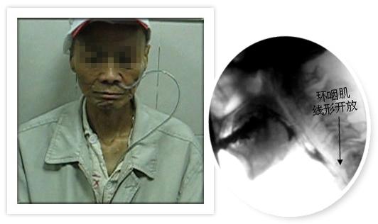 儿童手足口病脑干炎及脑外伤,脑肿瘤,脑瘫,喉软骨发育不良,唐氏综合症