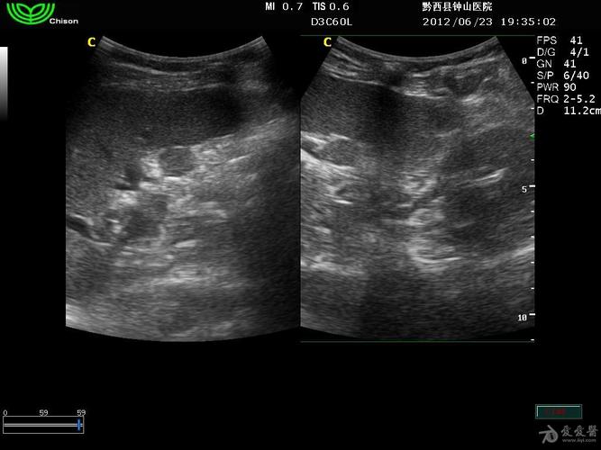 副脾- 超声医学讨论版 - 爱爱医医学论坛 - 爱爱医医学网