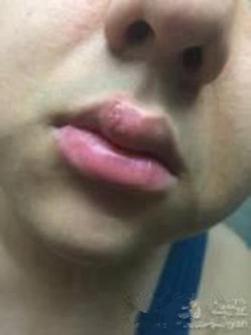 嘴唇疱疹初期图片