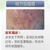 六,丘疹/脓包型痘痘丘疹型痘痘没有及时治疗导致痘痘恶化成为脓包