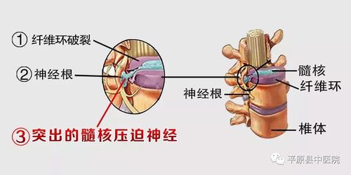腰椎间盘突出,颈椎病,是因为椎间盘纤维环破裂,里面的髓核从破裂的口