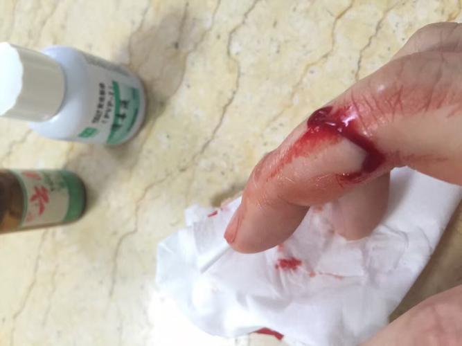 手被铁棍的扫把头割伤了,没打破伤风!今天第八天有点发烧