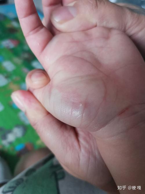 孩子手上长个小水泡,之前也长过一个.这个需要去医院吗.
