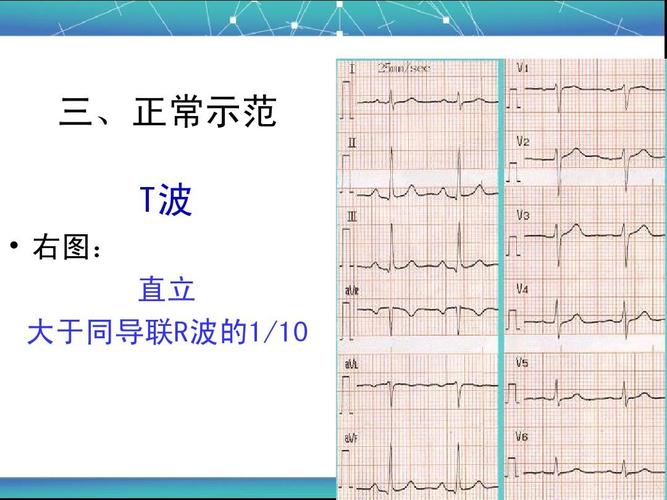 正常心电图1ppt