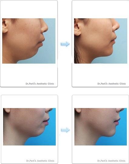 圣心整形——下巴手术图解