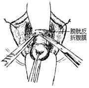 图8 剪开膀胱子宫反折腹膜