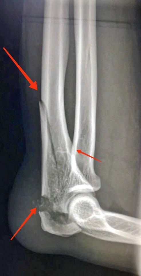 交通事故骨折的辨别:①尺桡骨骨折(珍藏版)