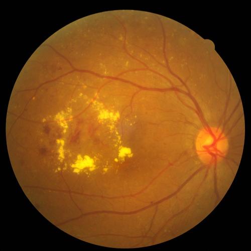 高度近视性黄斑病变包括黄斑出血,萎缩,漆样裂纹(bruch膜出现裂隙)及