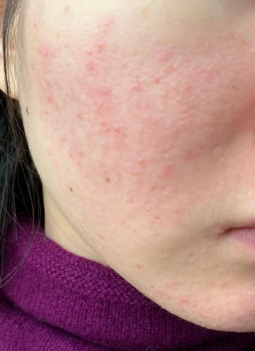 痤疮在青春期常时轻时重,没有一个一劳永逸的解决办法.