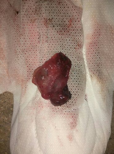 23:39    浏览  33333  推荐回答 来月经期间,有脱落的子宫内膜排出来