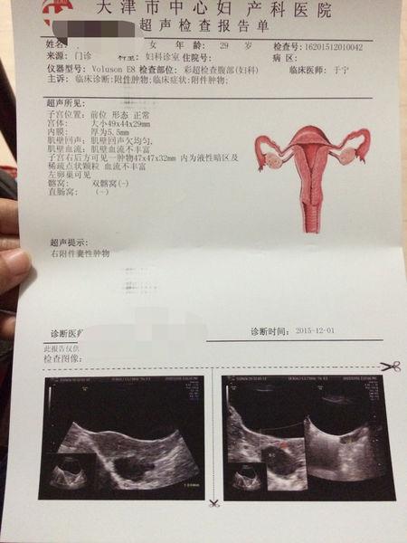 子宫右附件囊肿47*47*32,建议手术吗?