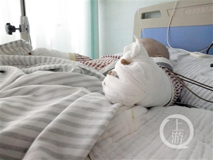 小林双手裹着纱布.