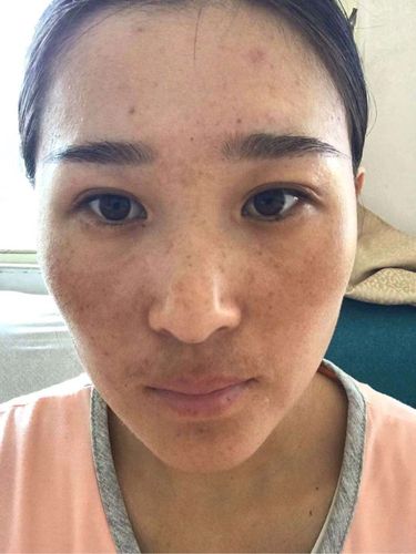 生完宝宝后一脸的斑 | 妈妈网轻聊_千万女人的共同选择