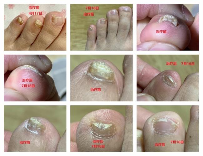 开帖记录下用口服药治疗灰指甲