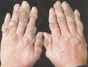 > 查看版本  疣状表皮发育不良 - 化验检查 组织病理:表皮过度角化,棘