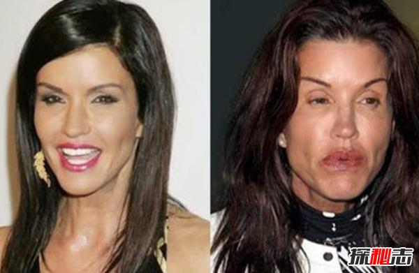 整容失败整容变毁容的15个真实案例附对比图片