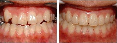 牙齿不齐做隐形矫正治疗效果怎么样