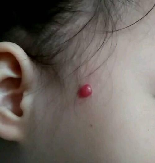 脸上长血管瘤怎么治,血管瘤病人吃什么好