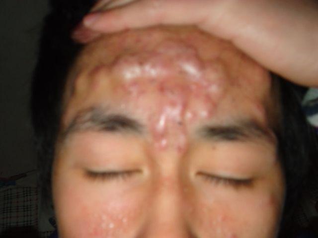 额头上长很多痤疮