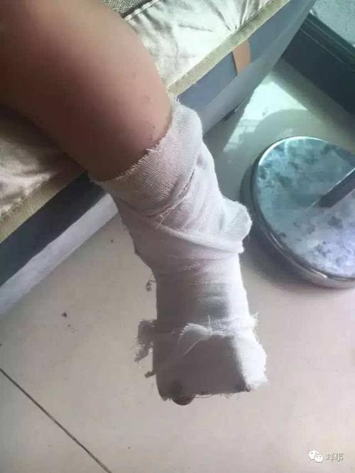 小明左脚脚趾骨折,缝了4针.