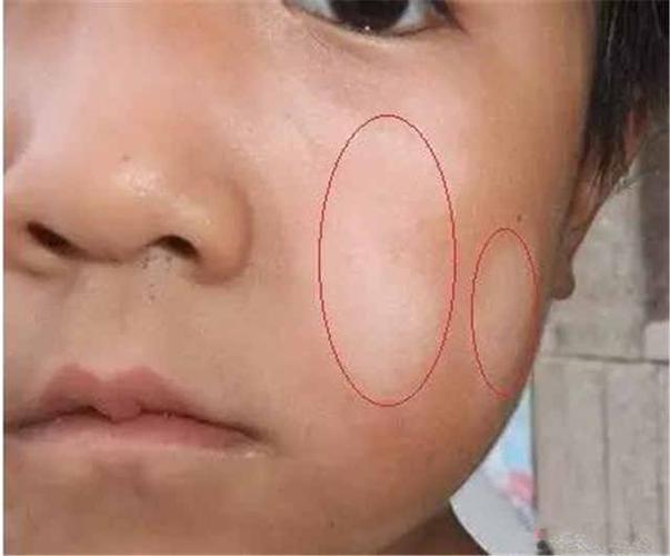 老人们说宝宝脸上长白斑是肚里有蛔虫,然而真相是.