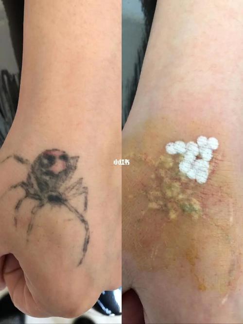 超皮秒 #点阵激光 #洗纹身 洗纹身第一次效果未恢复完