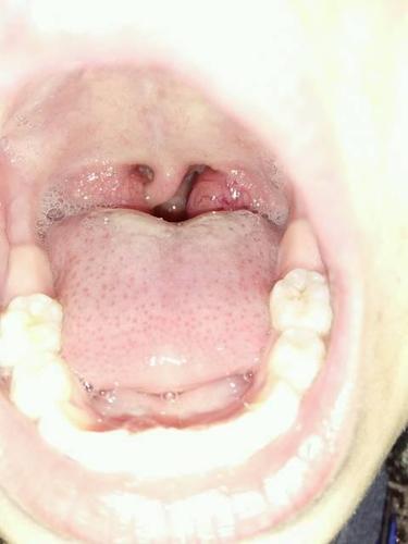 小孩扁桃体肿大3度一定要割掉吗