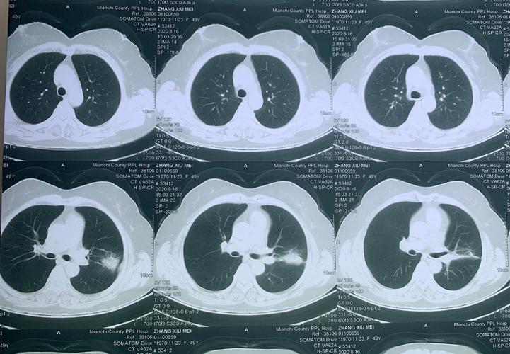 肺部ct检查:左肺空洞闭合了,病变缩小了,继续给予药物治疗.
