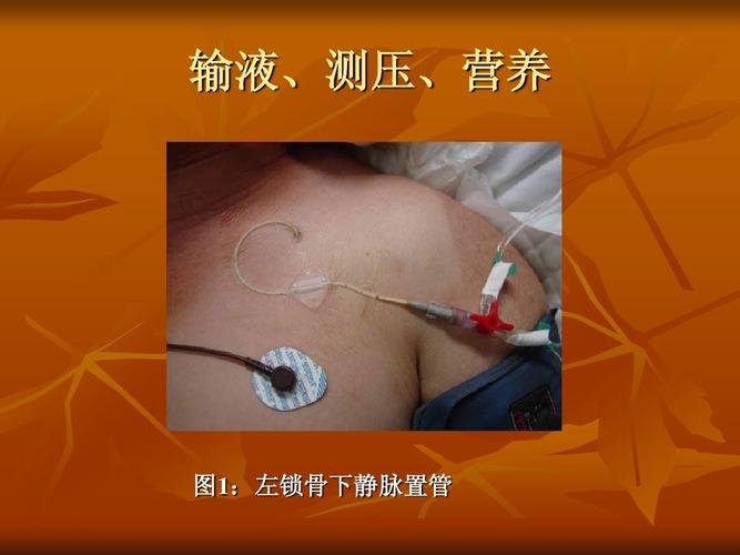 输液,测压,营养    :左锁骨下静脉置管