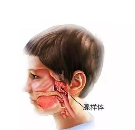 什么是腺样体肥大的罪魁祸首有哪些危害