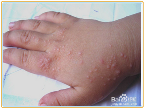 小孩手上起湿疹怎么办