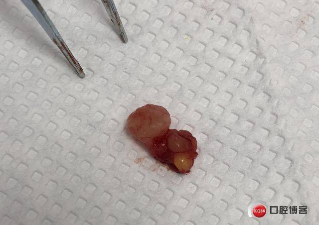 一例粘液腺囊肿局麻下摘除病例
