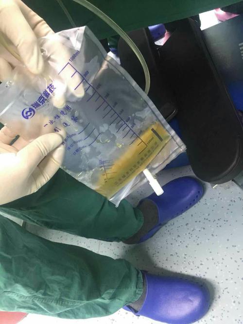 宿迁市儿童医院呼吸科完成闭式引流大量胸腔积液 支气管镜检查,灌洗