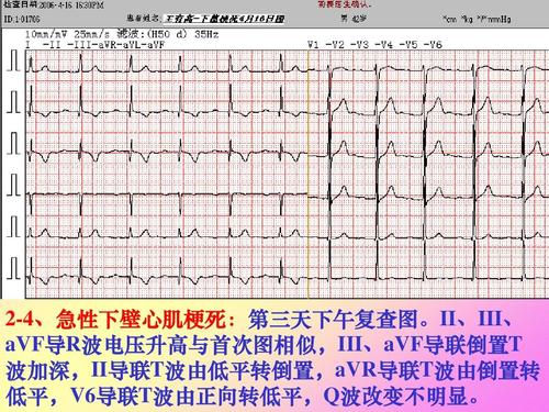 急性心肌梗死心电图演变ppt