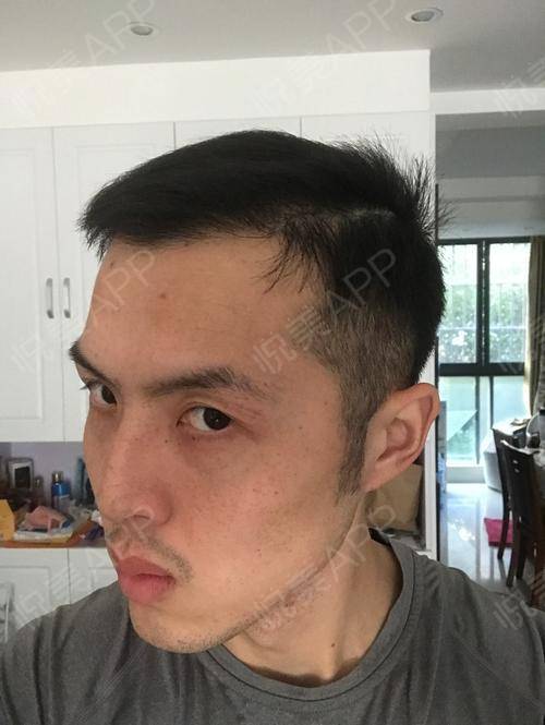 鬓角种植术后169天_头发种植术后169天_面部毛发种植术后169天_头部