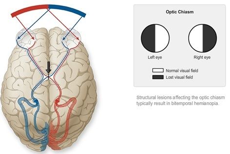 图6. 视交叉的结构损害引起双眼颞侧视野的偏盲.
