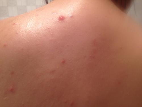 问:身上后背和胸前都是这种痘痘,怎么回事,刚洗了澡起来变得大,油油的