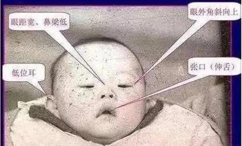 据郑飞医院妇产科主任董焕妮介绍,每位孕妇都有可能生育唐氏儿,风险