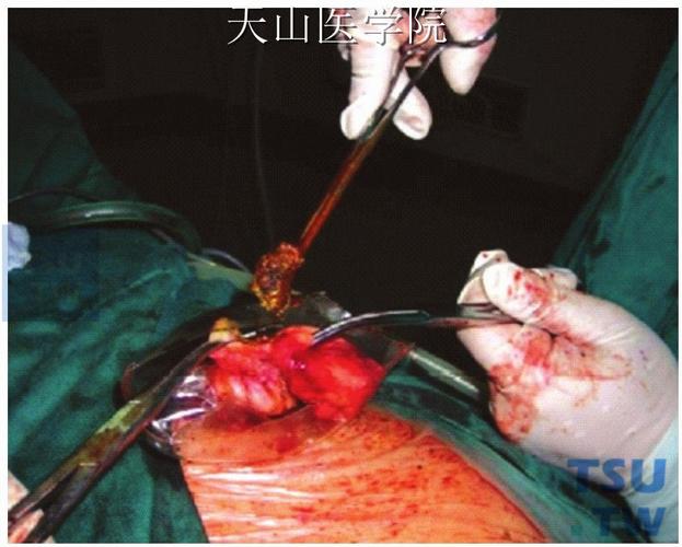 胆囊颈部切开吸尽胆汁,以取石钳碎石后取出胆囊