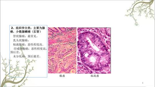 结肠癌根治术课件