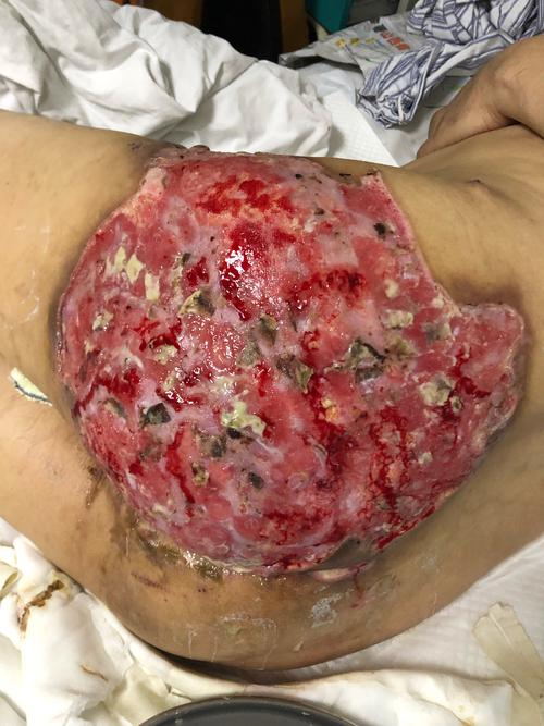 山西省人民医院肛肠科 原位皮肤邮票植皮术治疗化脓性