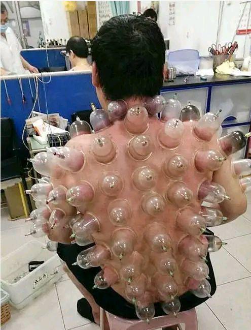 3.男子去店里拔火罐,后背这么多瓶子,这得有多疼呀!