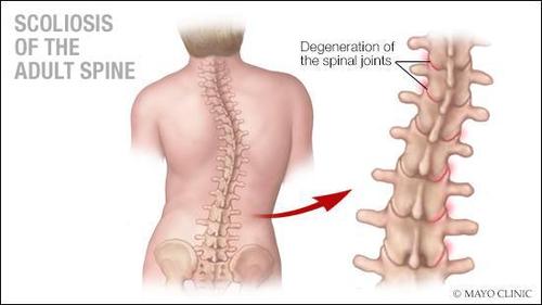 出国看病小科普:脊柱侧凸常发生的年龄拐点