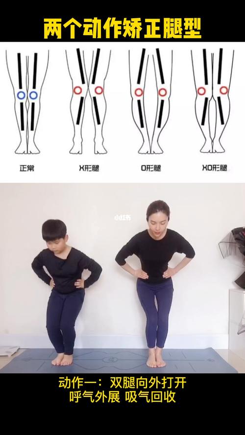 矫正x型腿,o型腿,xo型腿_o型腿_腿型_长高_腿型矫正_运动健身_健身