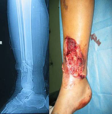 脚踝骨折 十一个钢钉 术后一个月就能走路了.