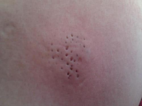 发炎痘痘是螨虫变多的典型现象之一,螨虫在某个区域的毛孔里进进出出