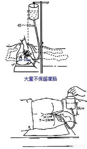 临床上给予灌肠的目的有清洁肠道;稀释肠道内的毒素,从而减少毒素的