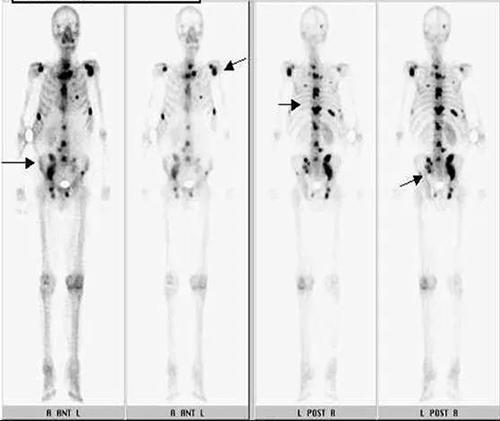 intevo bold spect/ct投入临床使用  全身骨显像(骨扫描)  :可早期